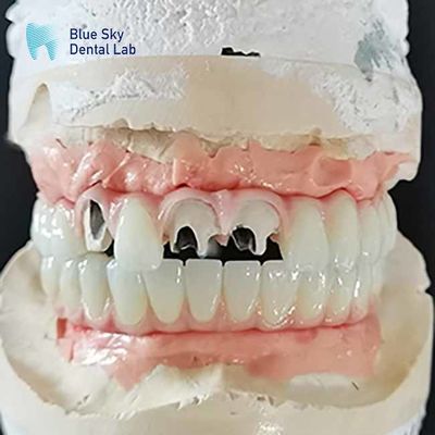 comprare Ponte di titanio Malo Implantazione ponte senza abutment multi-unità cementabile online manufacture