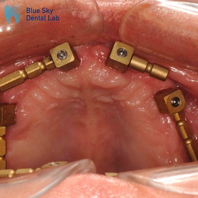 comprare Corpo di scansione multiunitario in oro in titanio CAM System Corpo di scansione dentale online manufacture