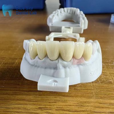 comprare Corone di zirconia a strati altamente traslucidi naturali con corona impiantata online manufacture