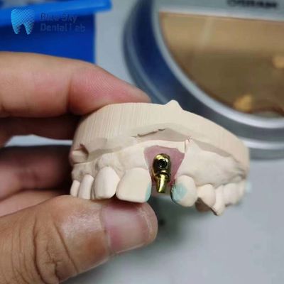comprare Casse per impianti regolari Customizabile singolo impianto dentale Offset Arch Implant Cassa online manufacture