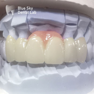 comprare Coroane in zirconia a strati di porcellana rosa Coroane dentali in zirconia per restauri estetici online manufacture