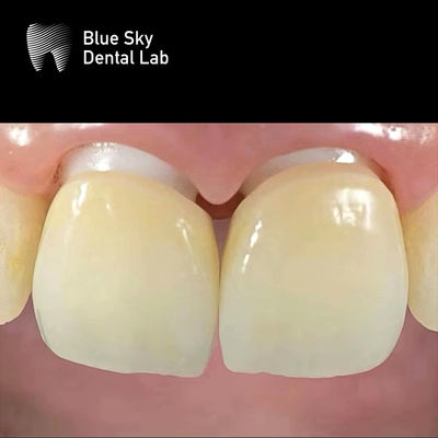 comprare Implantazione a strati di zirconia Corona di zirconia Abutment Biocompatibile online manufacture
