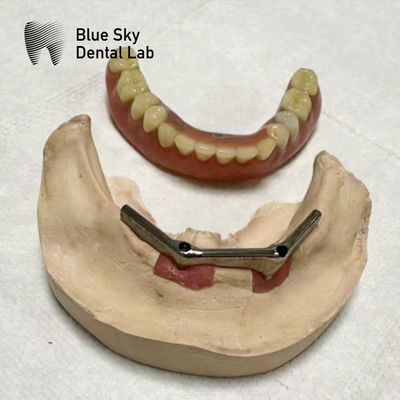 comprare Implantazione di protesi dentali con barra di titanio Implantazione dentale con protesi rimovibile online manufacture