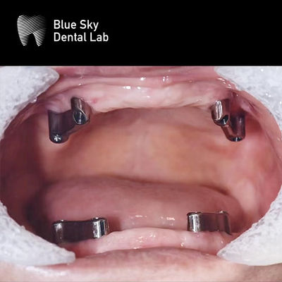 comprare Denti di resina Dental Titanio Bar rimovibile Blue Sky Implant System online manufacture