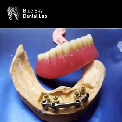 comprare Bar di titanio per denti a bocca intera Restaurazione dentale rimovibile accurata online manufacture