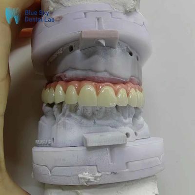 Casse per impianti dentali artificiali personalizzate