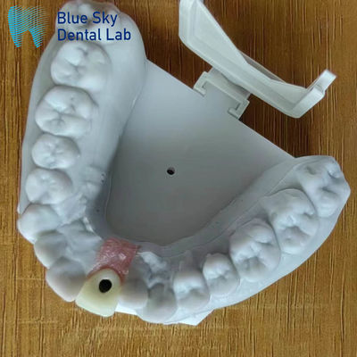 Sterilizzazione a vapore Corona di impianto singolo Corona di impianto dentale a superficie liscia