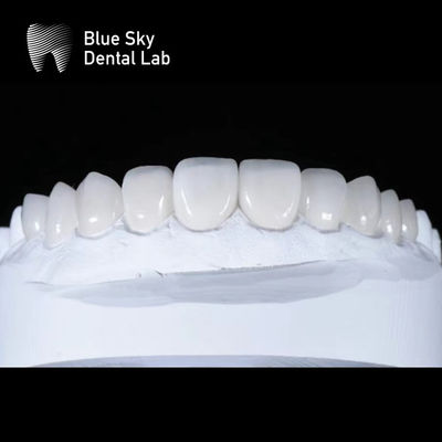 Casse di rivestimento elegante Premium 0,3 mm Rivestimenti Emax ultra sottili