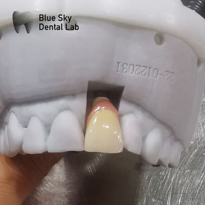 Casse per impianti dentali regolari Compatibilità universale Cassa per impianti dentali