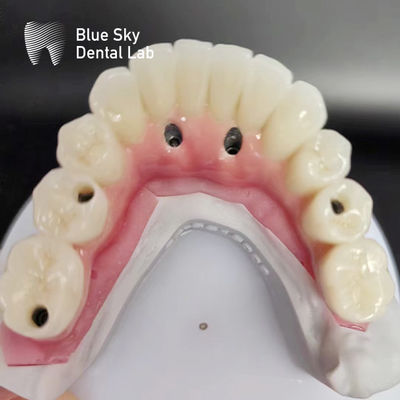 Casse per impianti dentali a arco completo compatibili con sistemi di impianti multipli