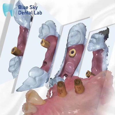 Scansione del corpo tutto in un capsula di guarigione dentale sistema di impianto blu cielo