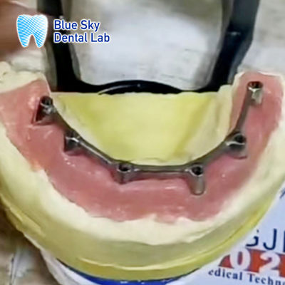 Implantazione rimovibile con dentiera in barretta di titanio