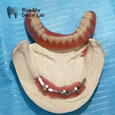 Impianto di Titanio Blu Sky Bar Dental per protesi dentali