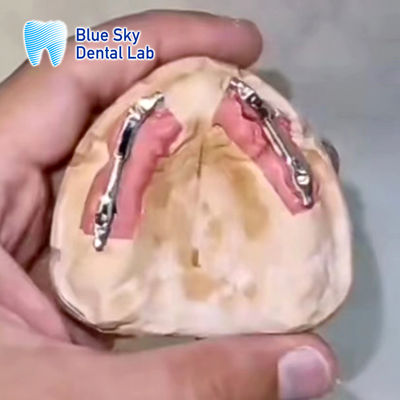 Implantazione dentale rimovibile in titanio a barra di segmentazione