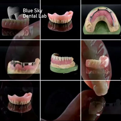 Bar di titanio dentale personalizzato universale con protesi acriliche