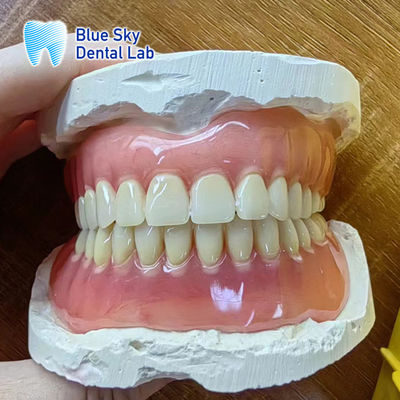 Denti mancanti Ristabilizione dentale completa acrilica Denti completa acrilica