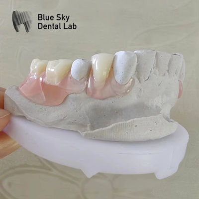 Sorrisa naturale Protesi dentali con valplast flessibile Protesi parziale rimovibile con valplast