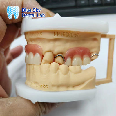 Ripristino del sorriso Protesi parziale acrilica con cerniere