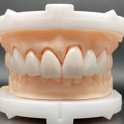 EMax Veneer Cases Passive Fitting in Multiple Colors MAKE Beautiful Smile con minima preparazione dei denti